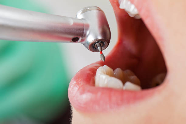 Best Emergency Tooth Extraction in Unicoi, TN